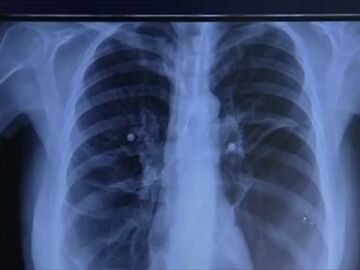 Administrar células madre en los pulmones de pacientes al borde de la muerte